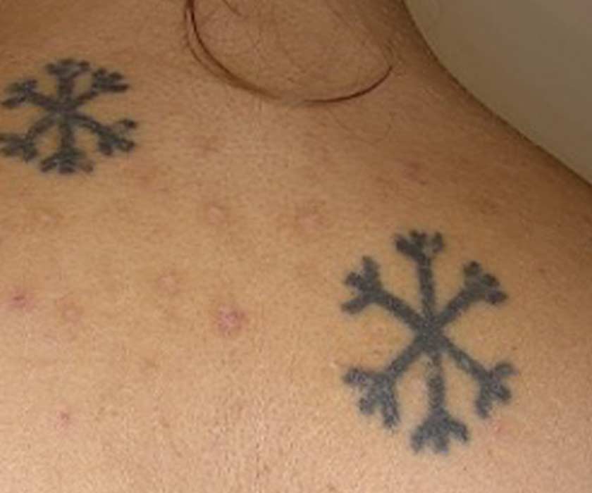 Tattooentfernung mit Laser, tattoofrei in Zürich