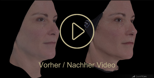 Biostimulator Vorher Nachher in Zürich bei AVORYA