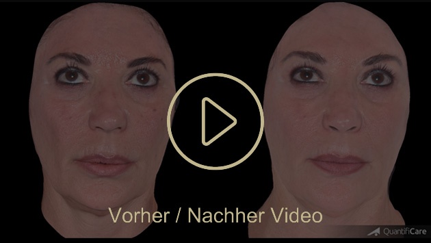 Biostimulator Vorher Nachher in Zürich bei AVORYA