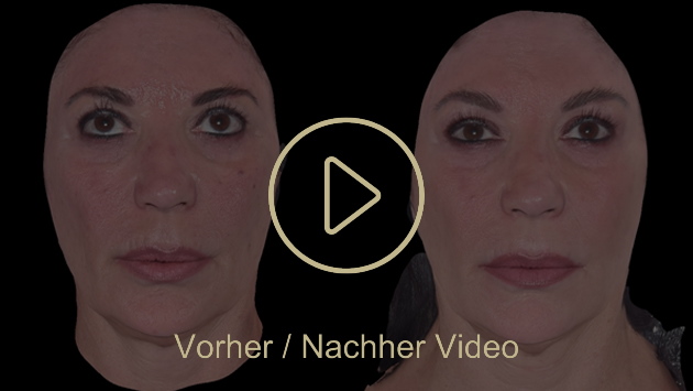 Biostimulator Vorher Nachher in Zürich bei AVORYA