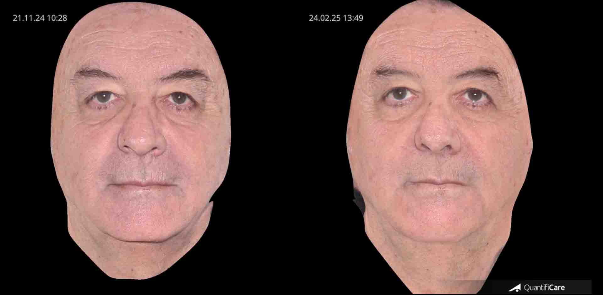 Kollagen Biostimulator Juläine Vorher Nachher in Zürich bei AVORYA