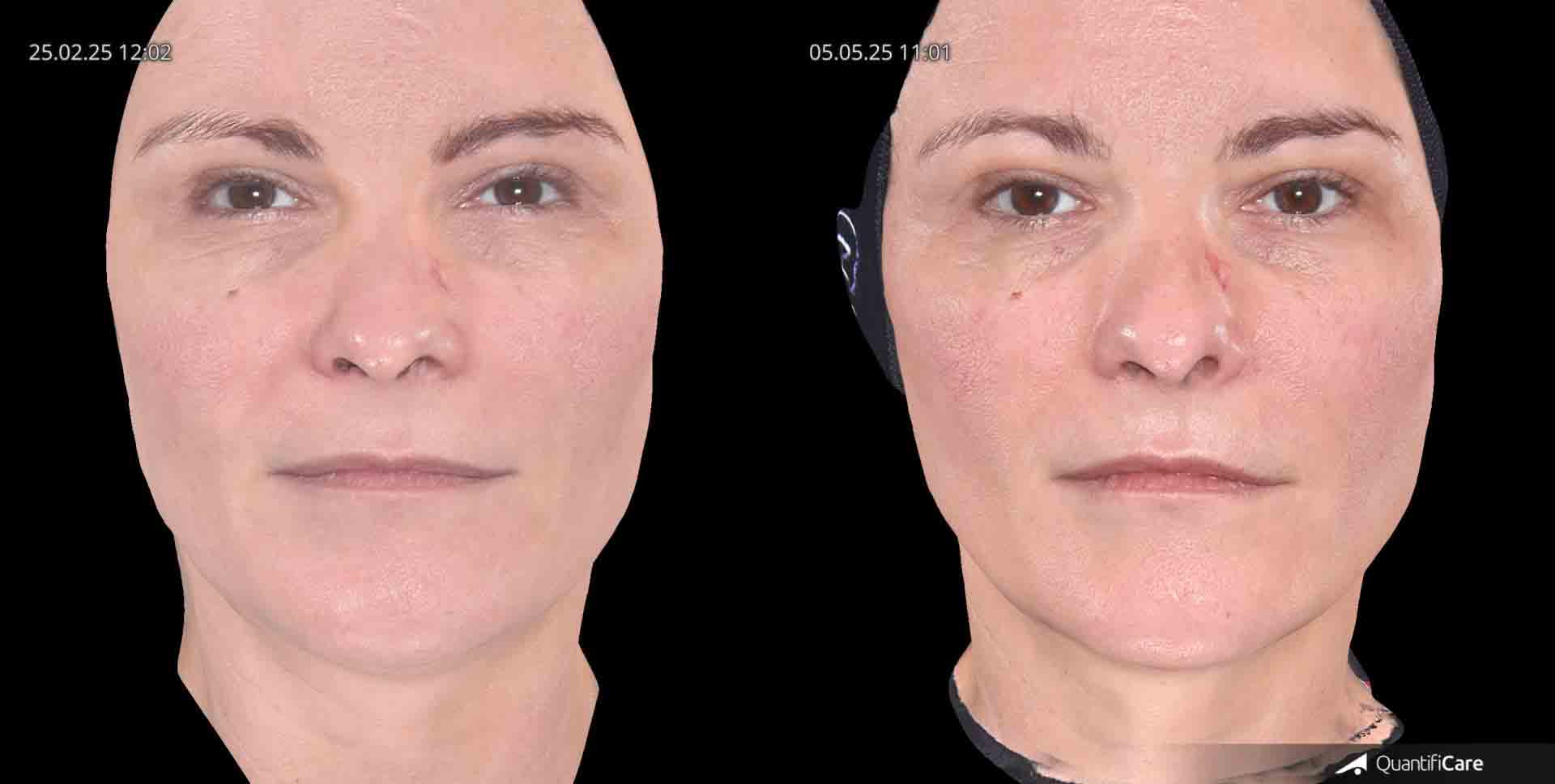 Kollagen Biostimulator Juläine Vorher Nachher in Zürich bei AVORYA