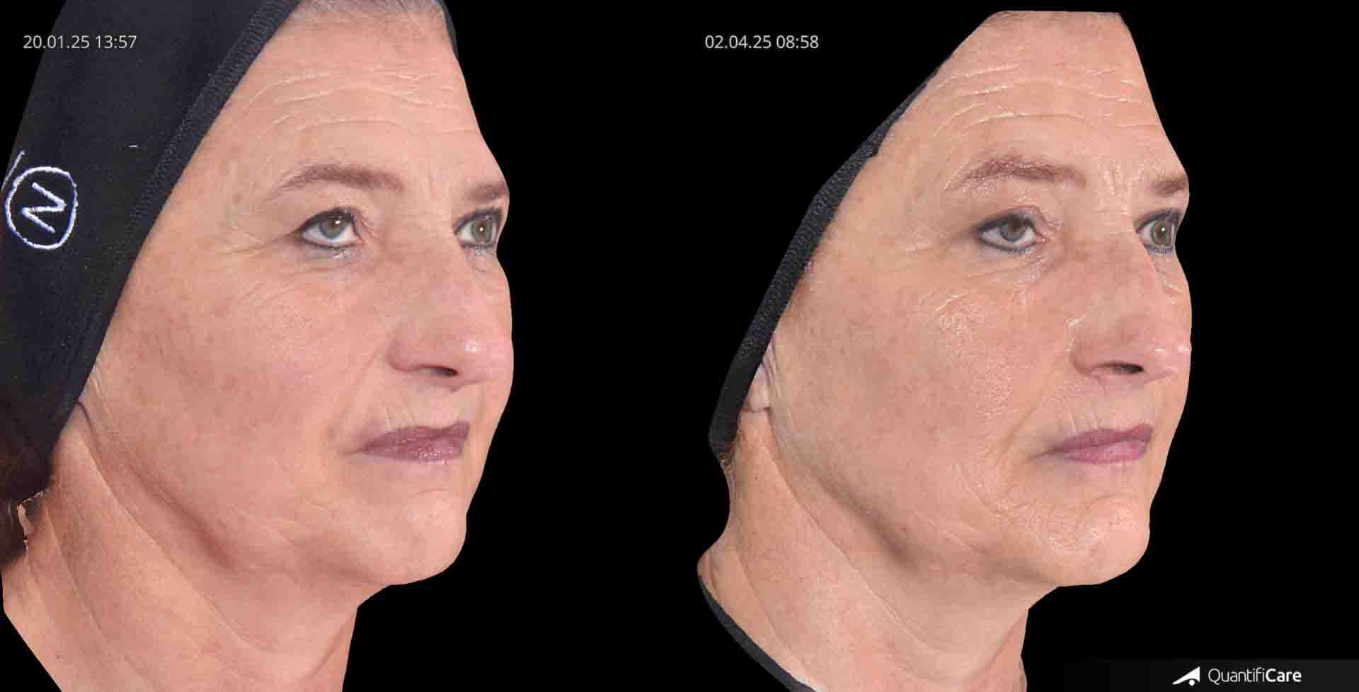 Kollagen Biostimulator Juläine Vorher Nachher in Zürich bei AVORYA
