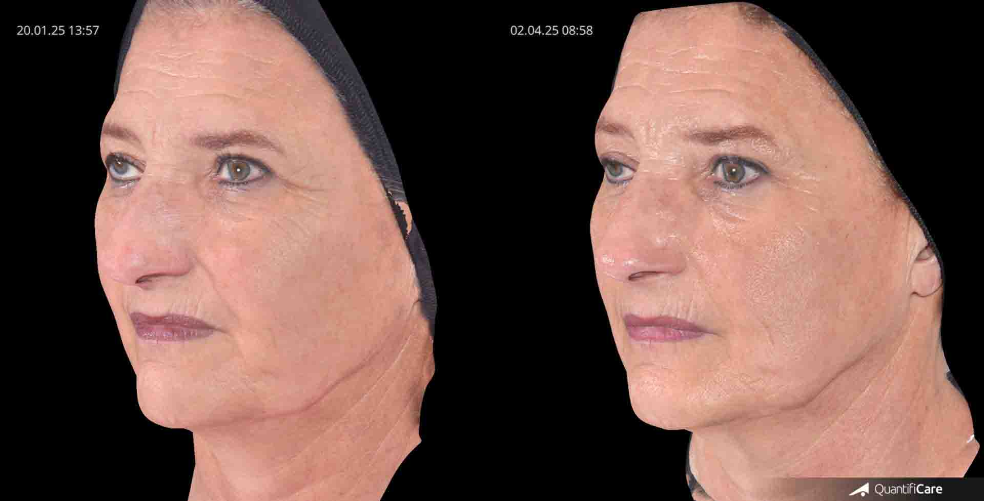 Kollagen Biostimulator Juläine Vorher Nachher in Zürich bei AVORYA