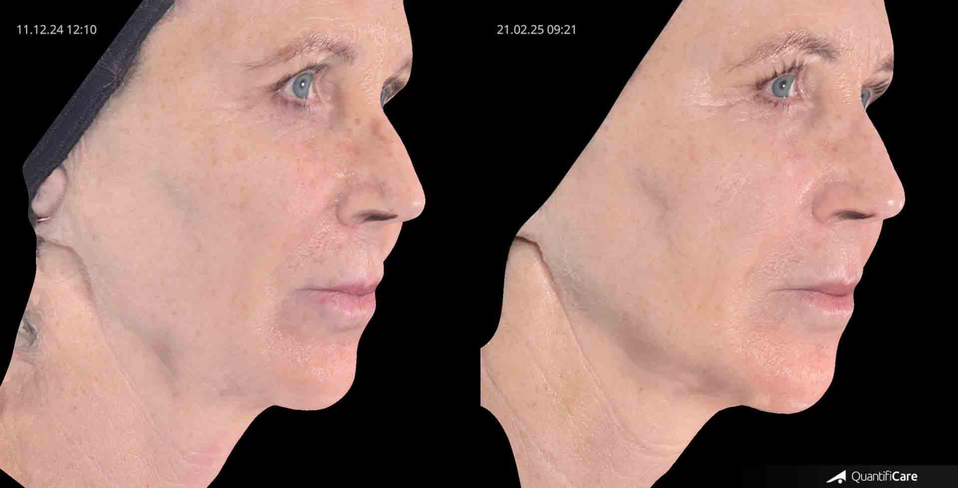 Kollagen Biostimulator Juläine Vorher Nachher in Zürich bei AVORYA