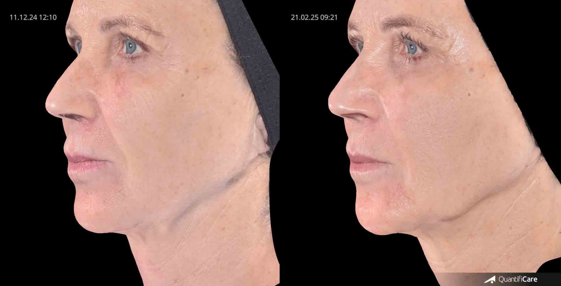 Kollagen Biostimulator Juläine Vorher Nachher in Zürich bei AVORYA