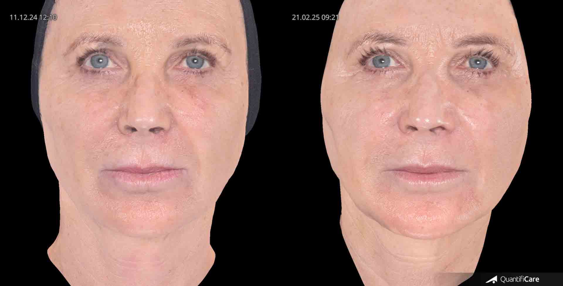 Kollagen Biostimulator Juläine Vorher Nachher in Zürich bei AVORYA