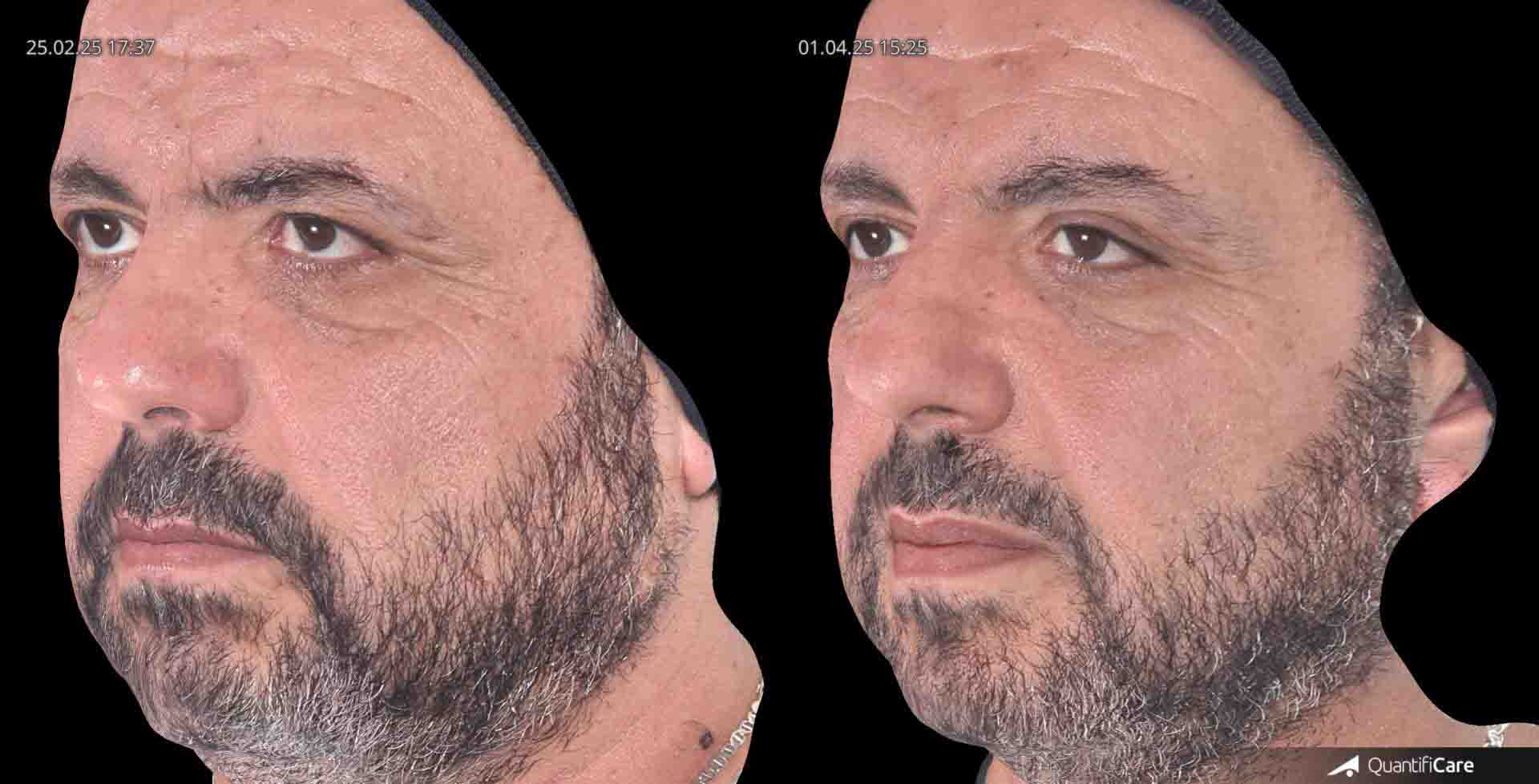 Kollagen Biostimulator Juläine Vorher Nachher in Zürich bei AVORYA