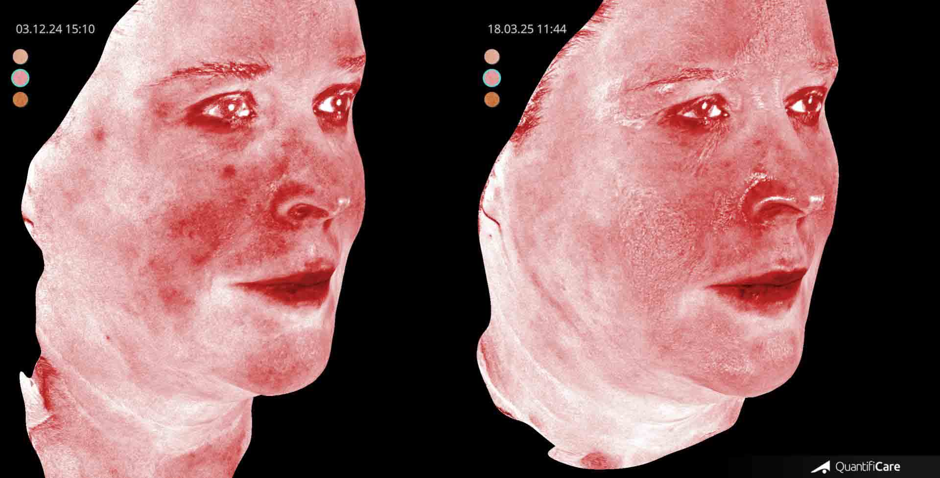 Kollagen Biostimulator Juläine Vorher Nachher in Zürich bei AVORYA