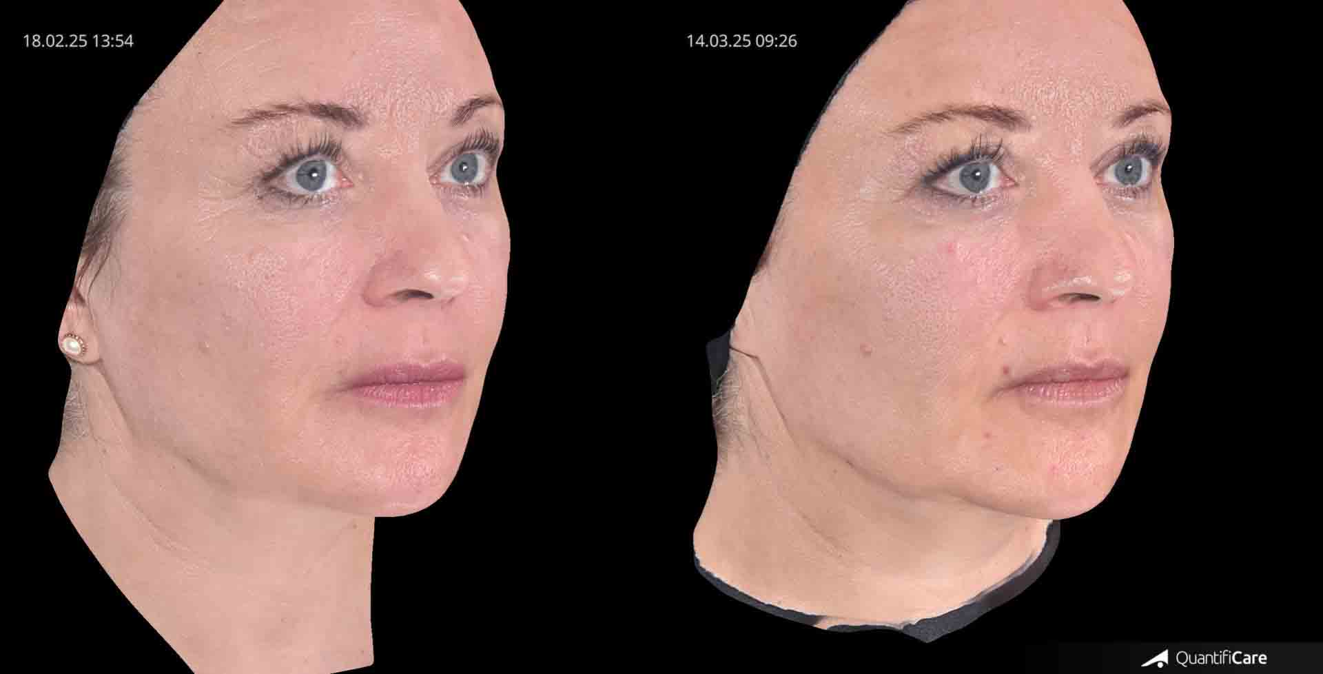Kollagen Biostimulator Juläine Vorher Nachher in Zürich bei AVORYA