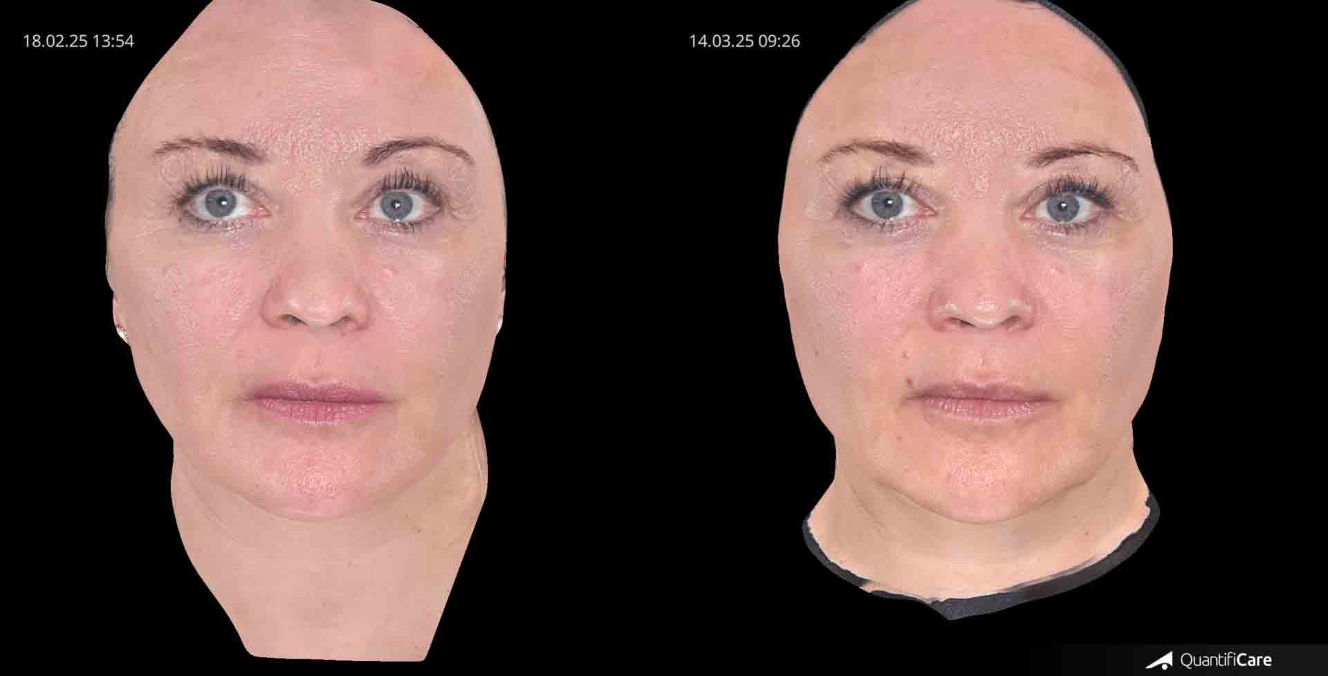 Kollagen Biostimulator Juläine Vorher Nachher in Zürich bei AVORYA