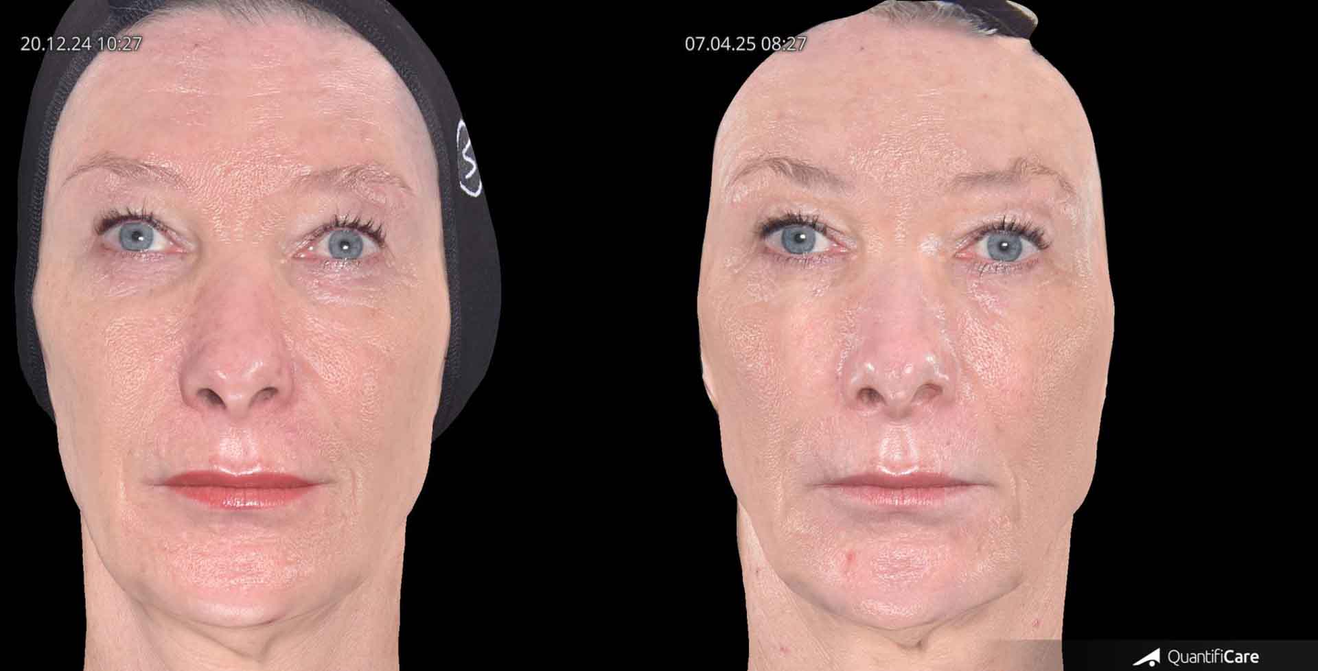 Kollagen Biostimulator Juläine Vorher Nachher in Zürich bei AVORYA