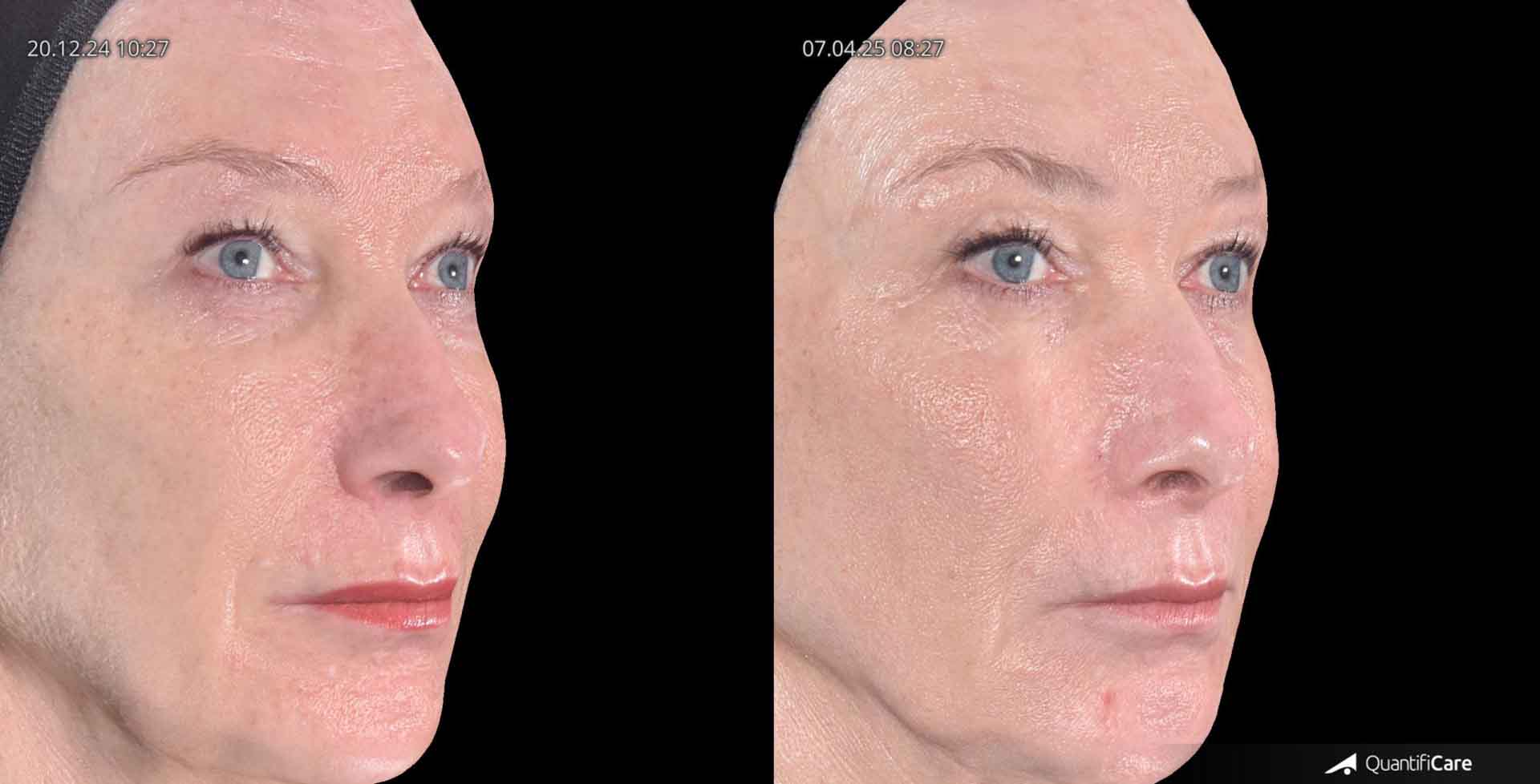 Kollagen Biostimulator Juläine Vorher Nachher in Zürich bei AVORYA