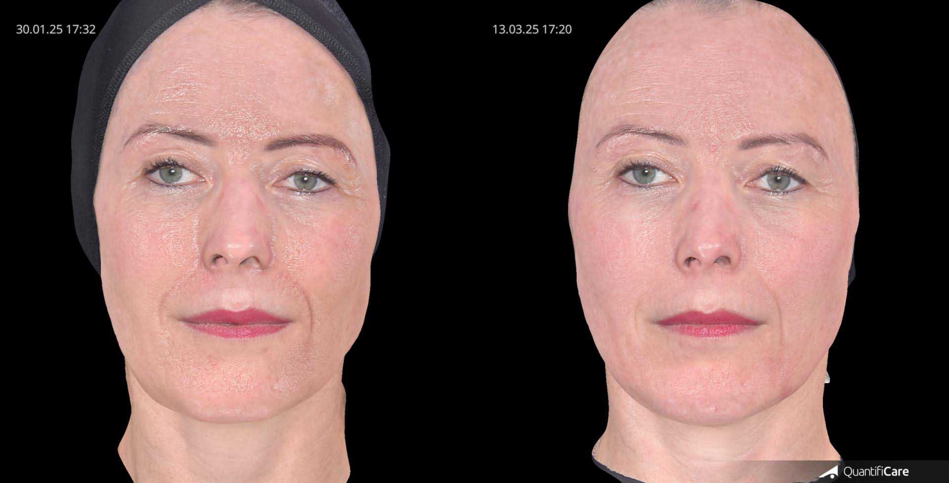 Kollagen Biostimulator Juläine Vorher Nachher in Zürich bei AVORYA