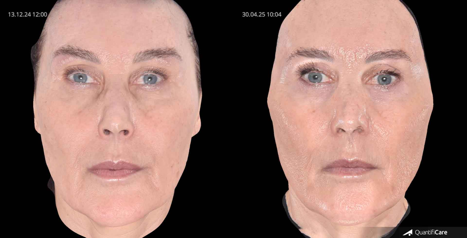 Kollagen Biostimulator Juläine Vorher Nachher in Zürich bei AVORYA