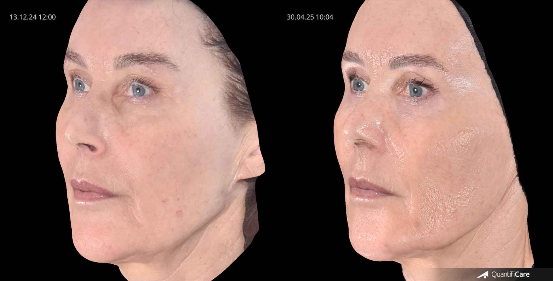 Kollagen Biostimulator Juläine Vorher Nachher in Zürich bei AVORYA