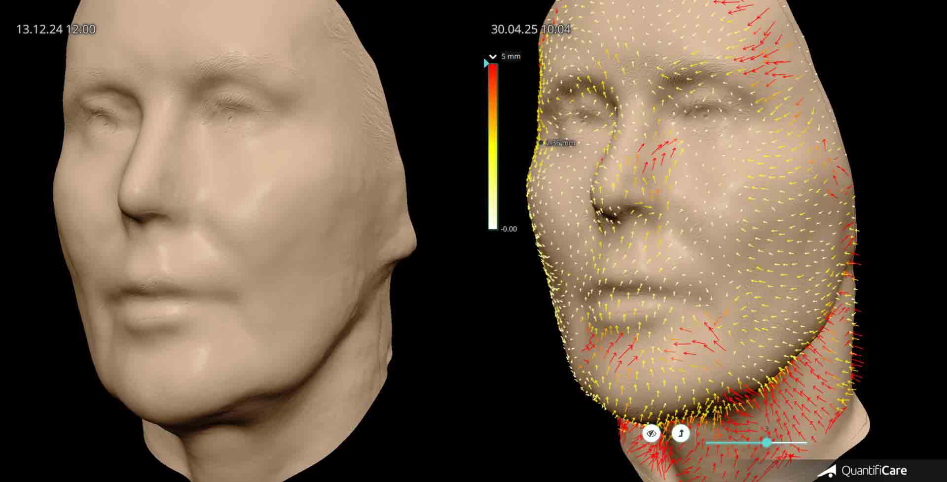 Kollagen Biostimulator Juläine Vorher Nachher in Zürich bei AVORYA