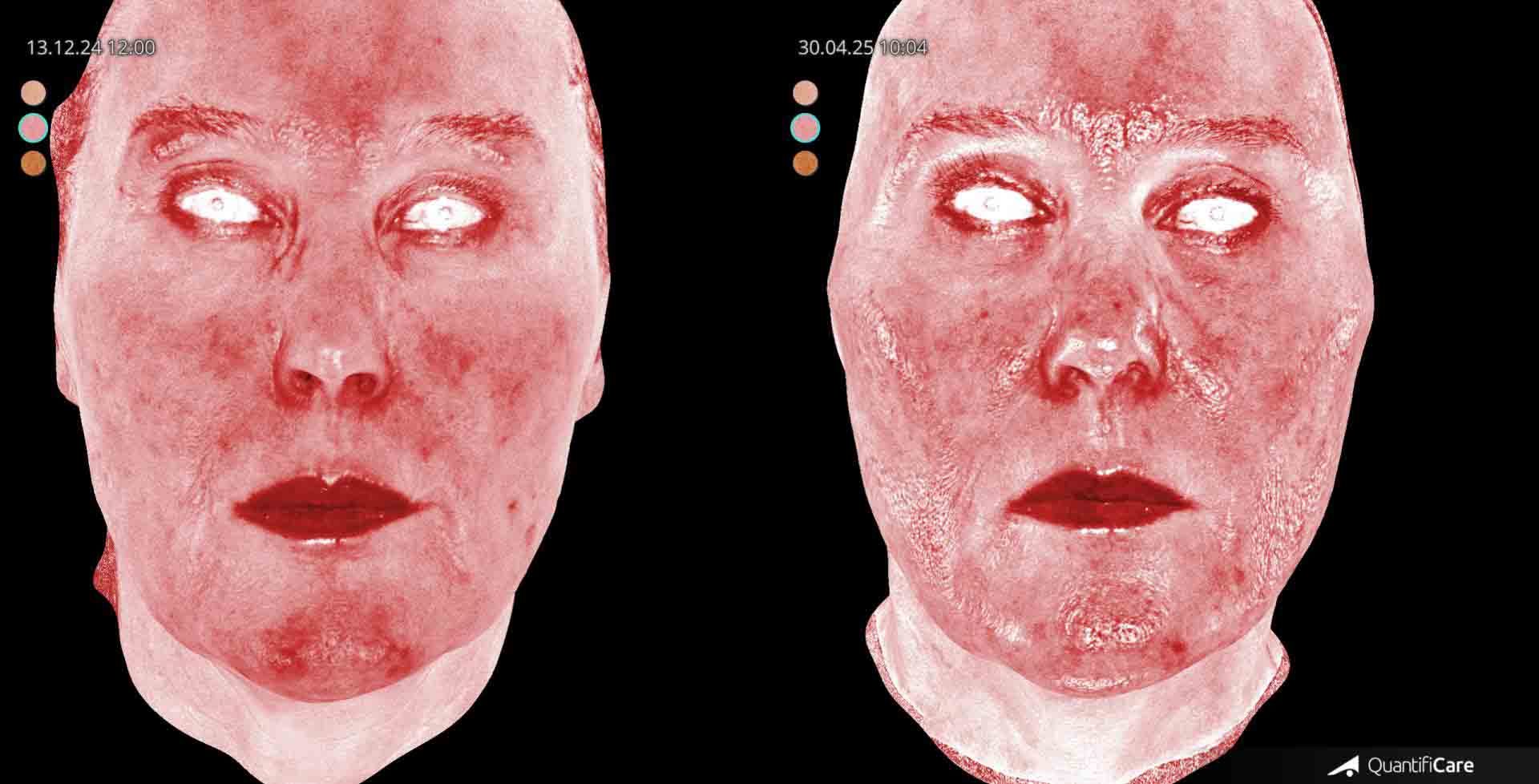 Kollagen Biostimulator Juläine Vorher Nachher in Zürich bei AVORYA