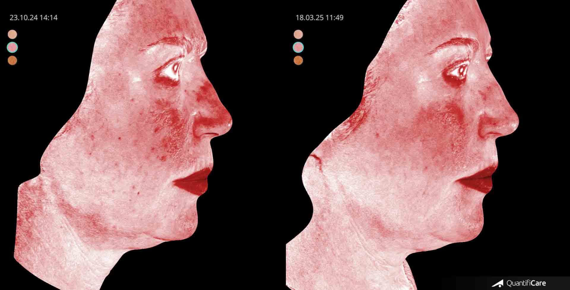 Kollagen Biostimulator Juläine Vorher Nachher in Zürich bei AVORYA
