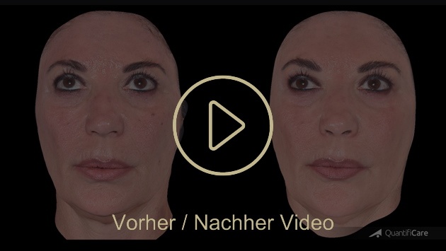 Biostimulator Vorher Nachher in Zürich bei AVORYA