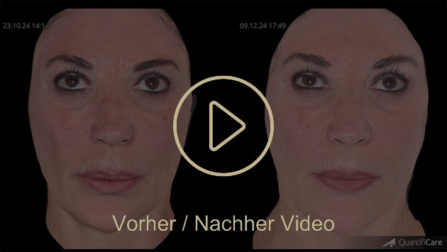 Biostimulator Vorher Nachher in Zürich bei AVORYA